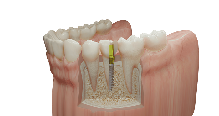 Premium Implantate