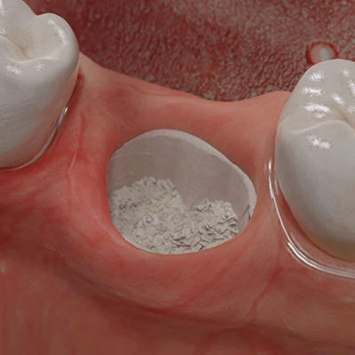 Leeres Zahnfach mit Zahngranulat